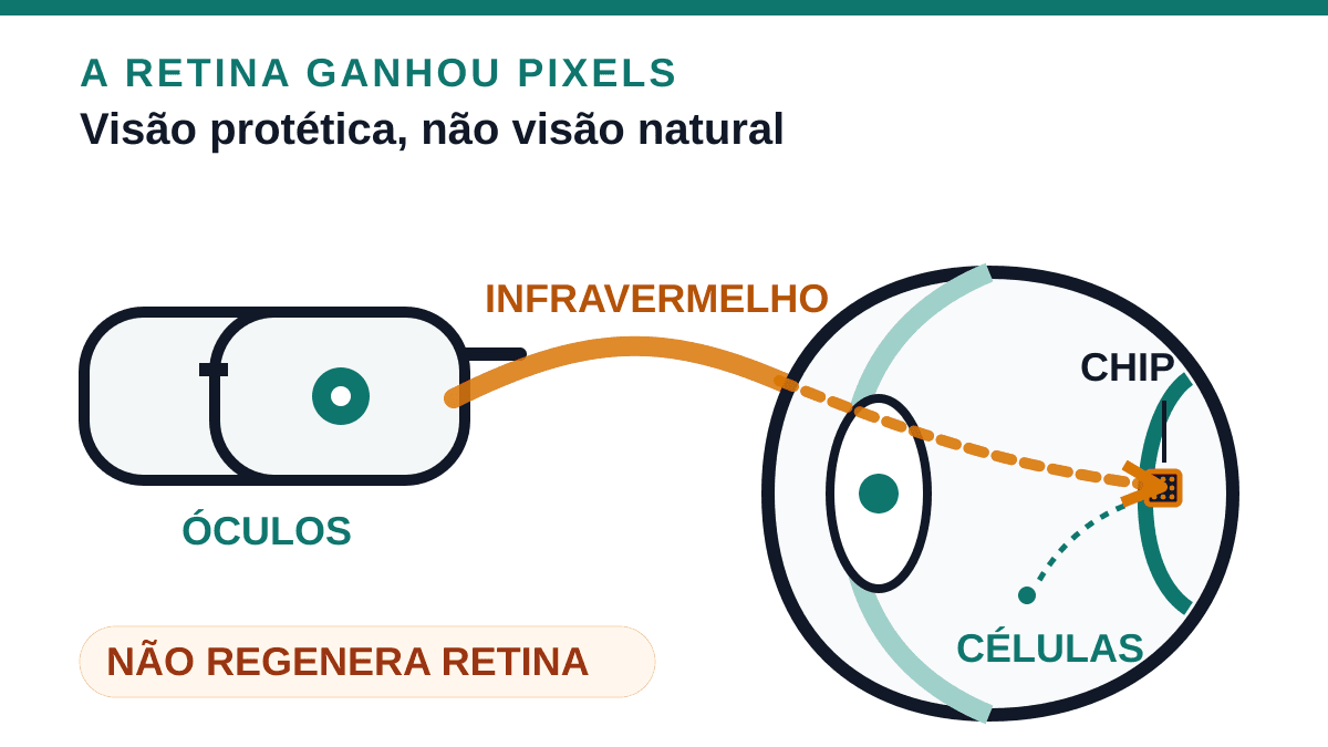 Esquema conceitual de óculos projetando luz infravermelha até um chip sub-retiniano que estimula células preservadas
