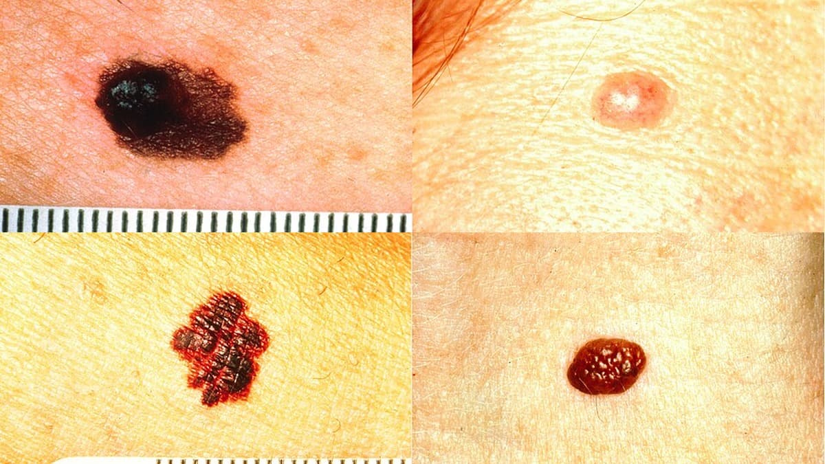 Quatro imagens dermatológicas comparando lesões pigmentadas e não pigmentadas