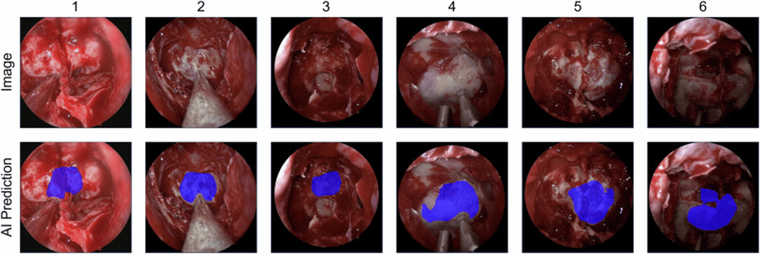 Seis imagens endoscópicas de cirurgia hipofisária comparadas com as mesmas imagens contendo a região prevista pela IA em azul